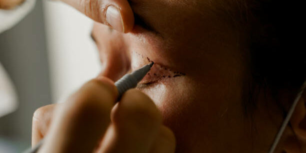 istockphoto-1266650273-612x612 Blepharoplasty markup on the face of a beautiful female before the plastic surgery operation for modifying the eye region of the face in medical clinic. 2 doctors do plastic cosmetic operation